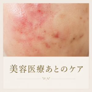 グリーンピールのビニール肌、薄い肌への効果と美容医療跡のケア