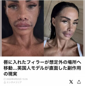 英国人気モデルが公表した「唇フィラー」の深刻な副作用