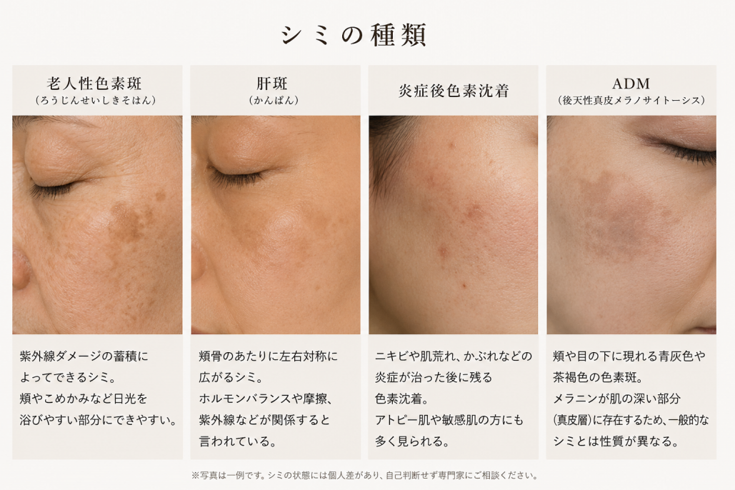 シミの種類・シミとりレーザーが効かないシミ